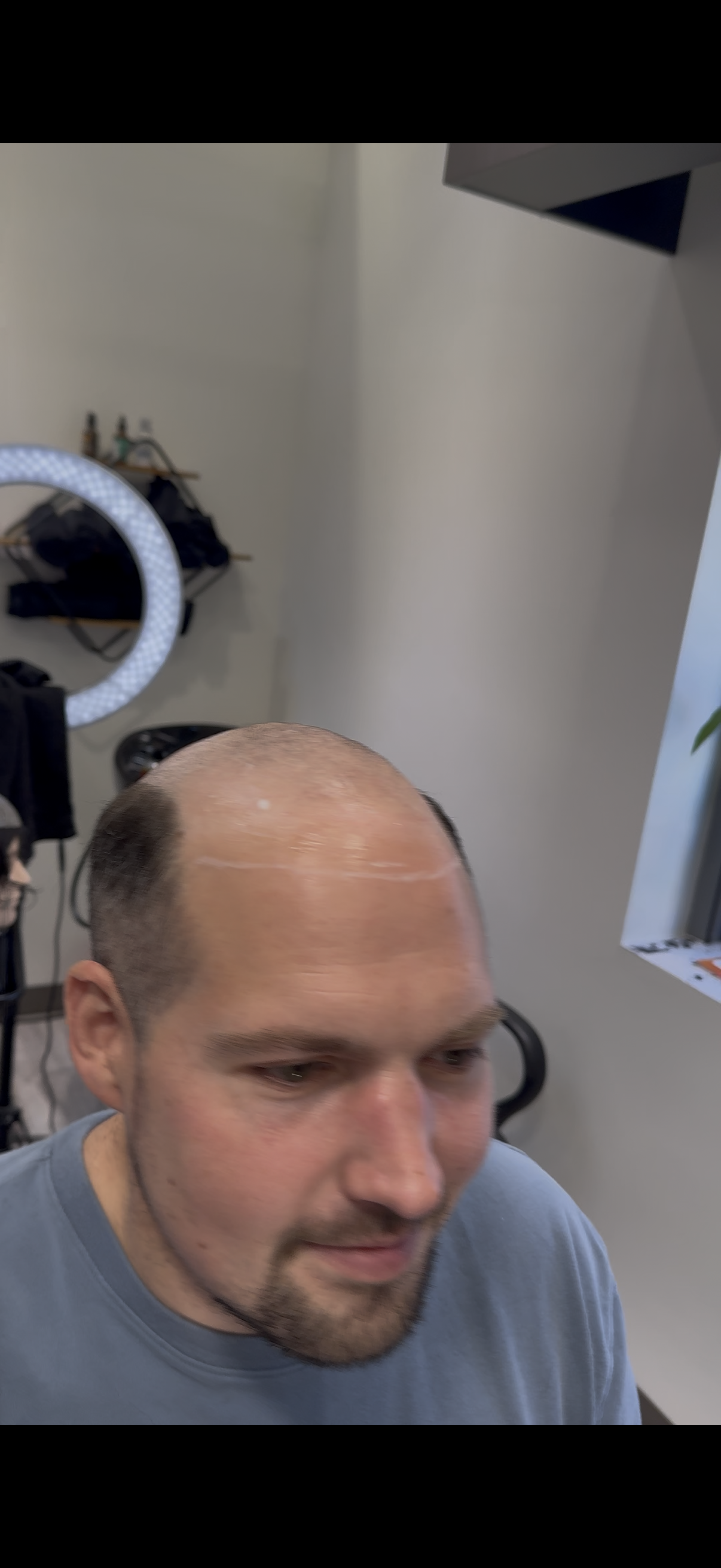 Hair replacement transformation result