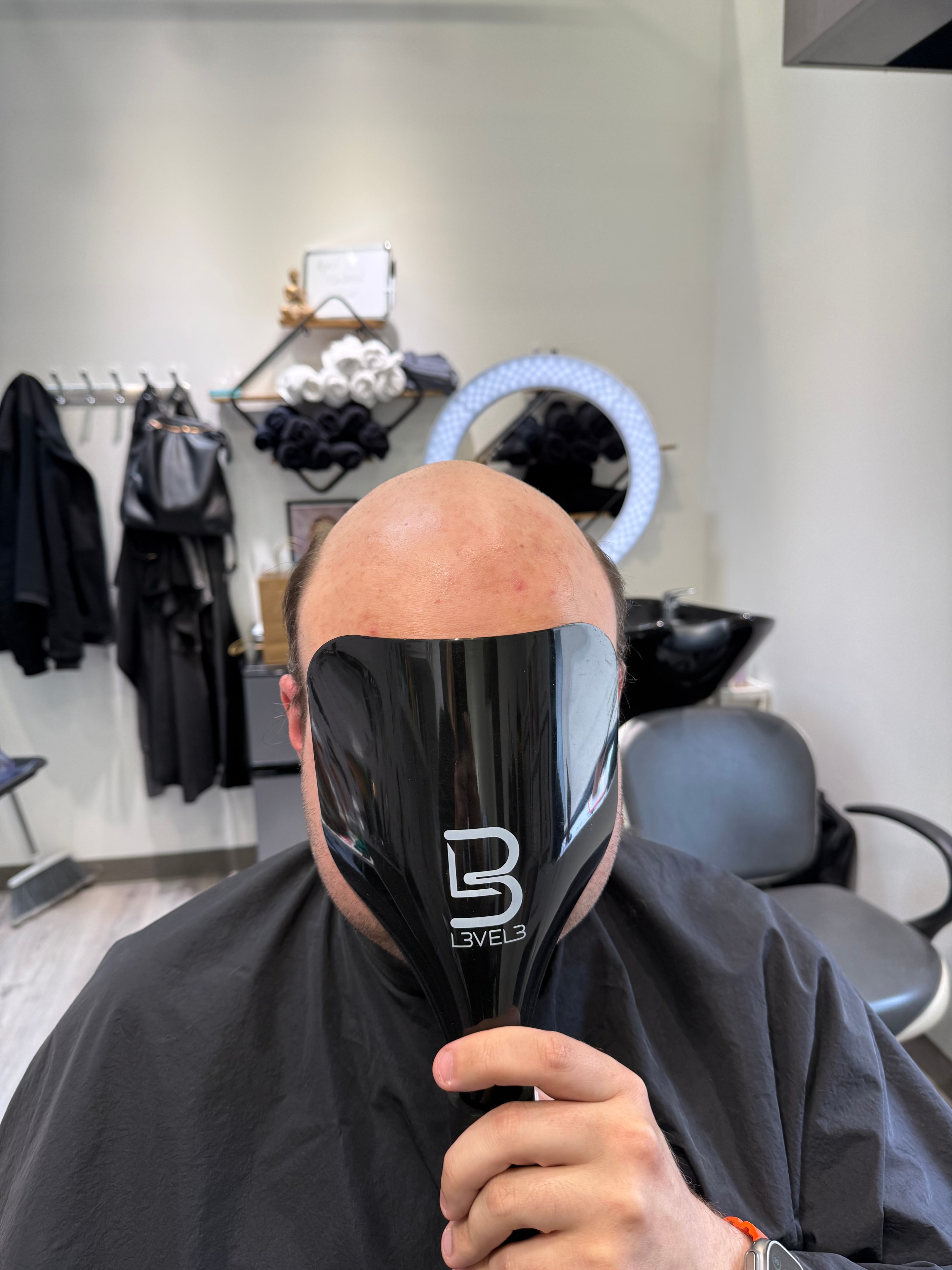 Hair replacement transformation result